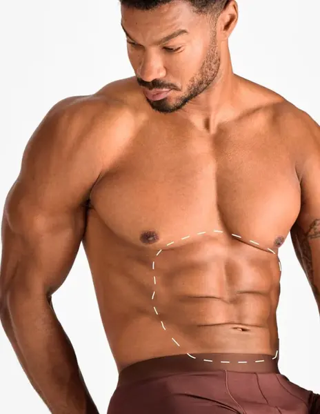 Abdomen – Epilare Definitivă cu Laser - 1 Sedinte