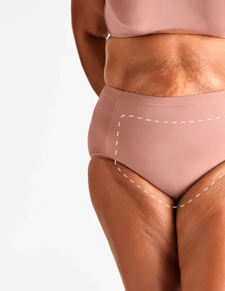Brazilian feminin – Epilare Definitivă cu Laser - 4 Sedinte