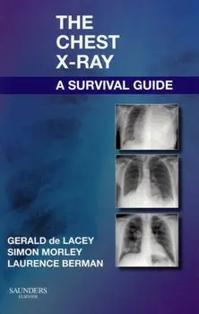 Chest X-Ray: A Survival Guide, Paperback/Laurence Berman