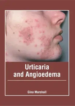 Urticaria and Angioedema, Hardcover/Gina Marshall